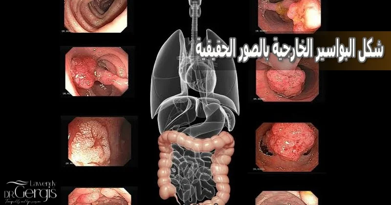 شكل البواسير الخارجية بالصور الحقيقية