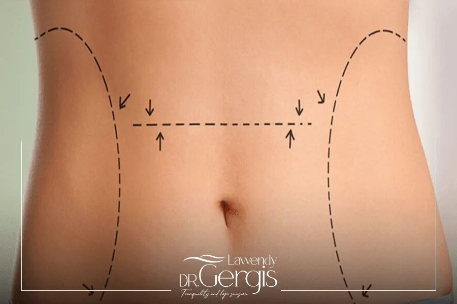 ما هو شفط الدهون بالفيزر